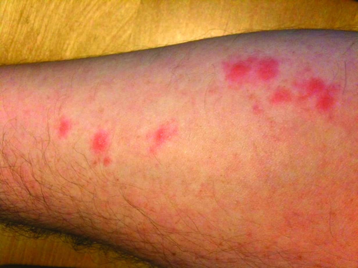 bed bug bites images